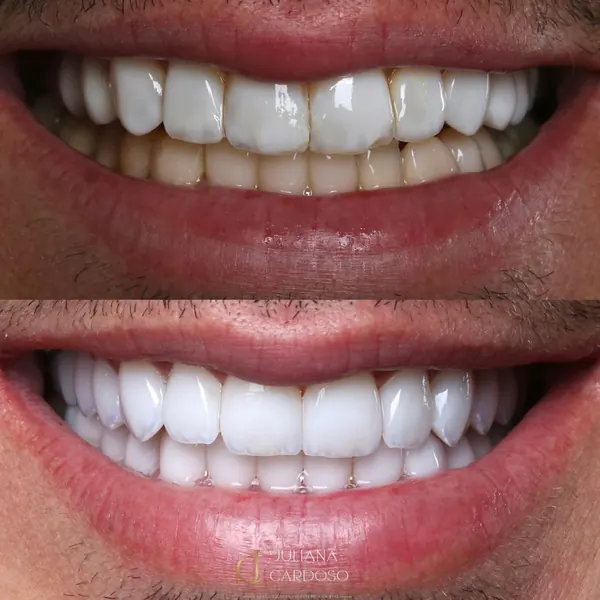 Antes (acima) e depois (abaixo) de um tratamento com lentes de contato dental