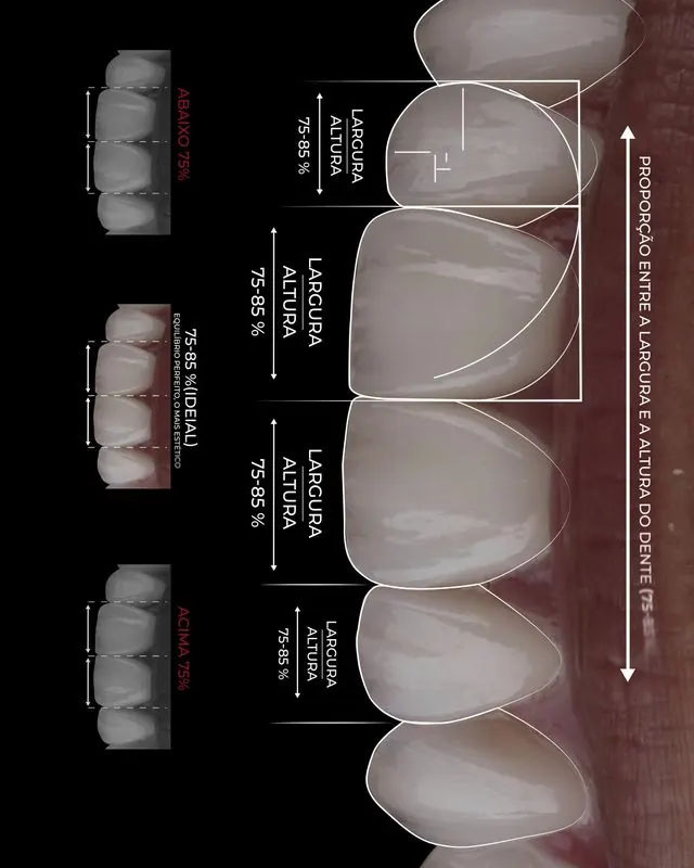Desenho das lentes com medidas de largura e altura de cada dente