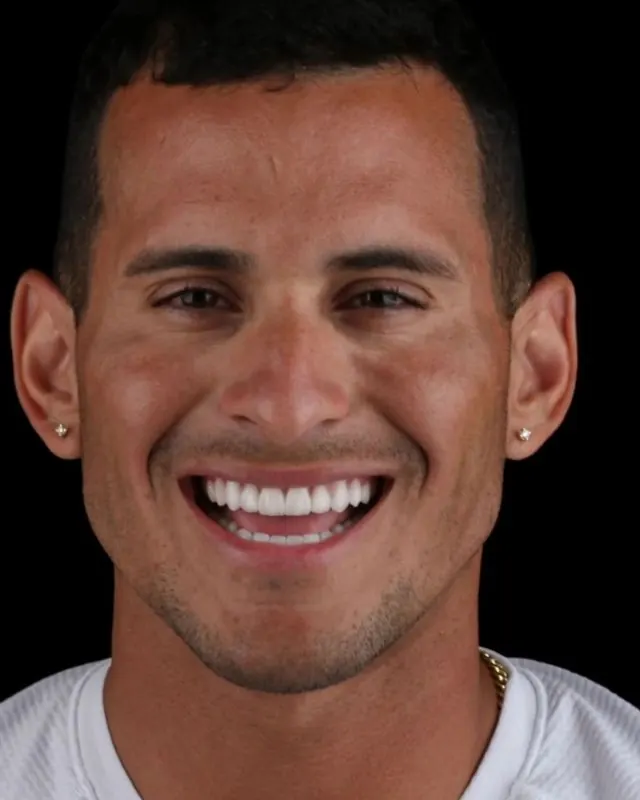 Resultado final do sorriso do paciente