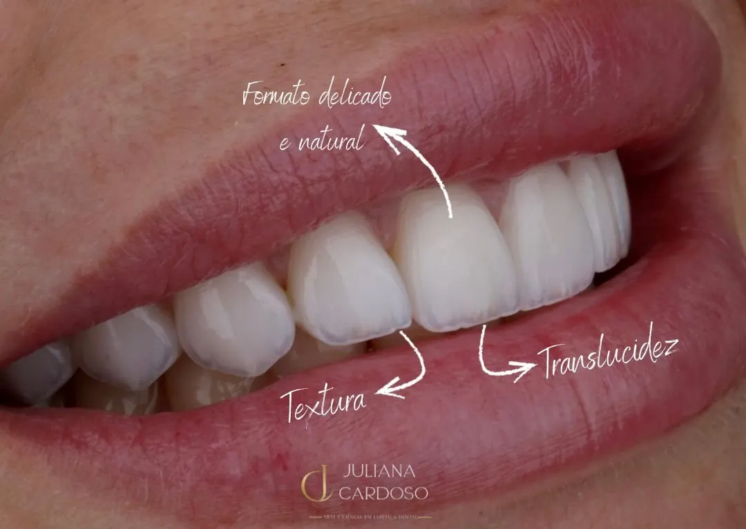 Lentes de contato dental com formato delicado, textura e translucidez naturais